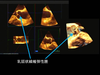 乳頭状線維弾性腫