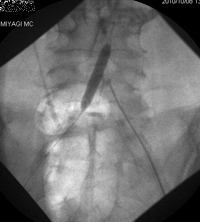 血管内治療（ステント留置）