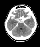 くも膜下出血のCT